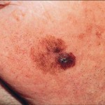 cos-e-il-melanoma-2 Lentigo maligna
