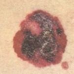 Melanoma superficiale