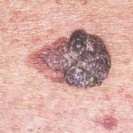 cos-e-il-melanoma-1 Melanoma nodulare