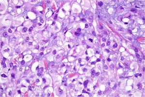 Melanoma mixoide