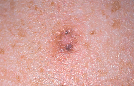 Melanoma desmoplastico