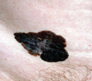 melanoma maligno a diffusione superficiale