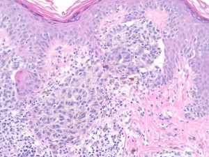 melanoma nevoide