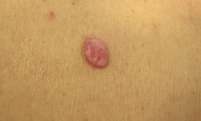 melanoma amelanotico