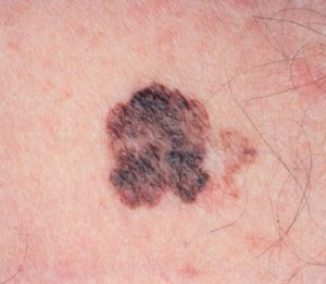 Fattori di rischio :: Melanoma