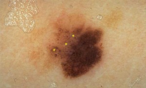 Melanoma maligno