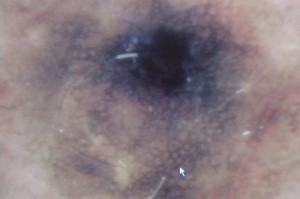 Melanoma