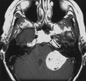 Il melanoma del sistema nervoso centrale