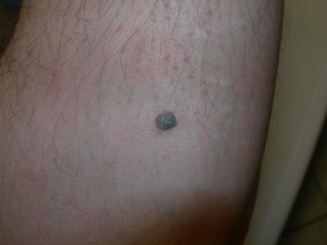 Melanoma maligno nodulare