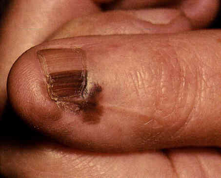 Melanoma ungueale