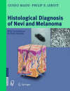 histological diagnosis melanoma