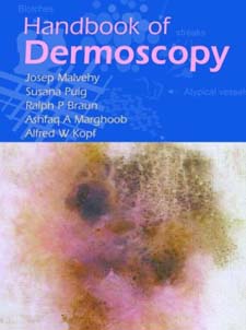 malvety, dermatoscopy