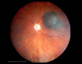Melanoma dell'occhio
