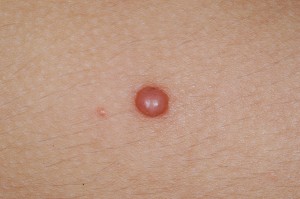 spitz nevus