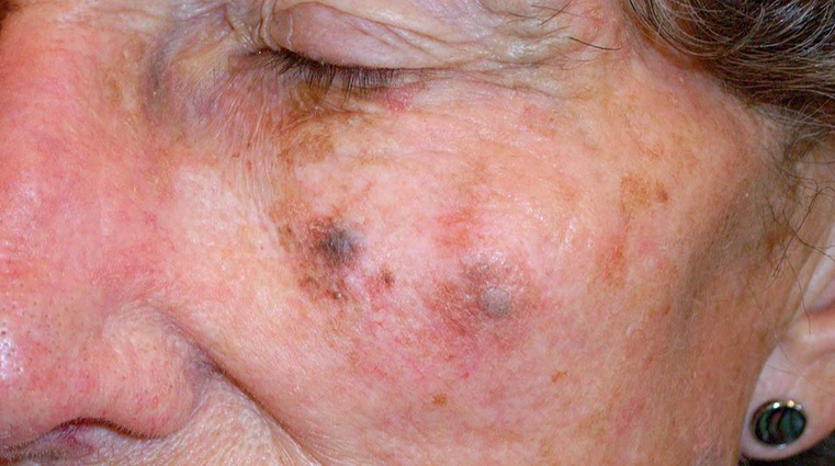 Lentigo maligna melanoma