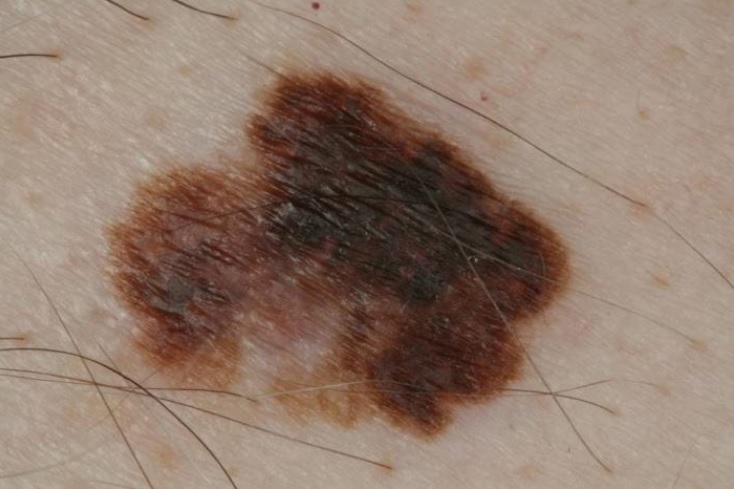 Melanoma maligno a diffusione superficiale