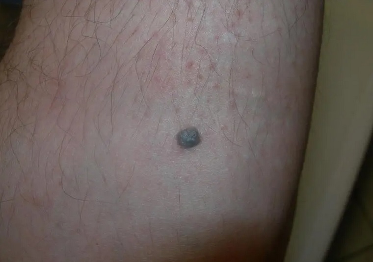 Nodular malignant melanoma