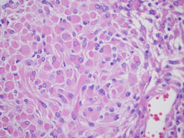 Melanoma rabdoide